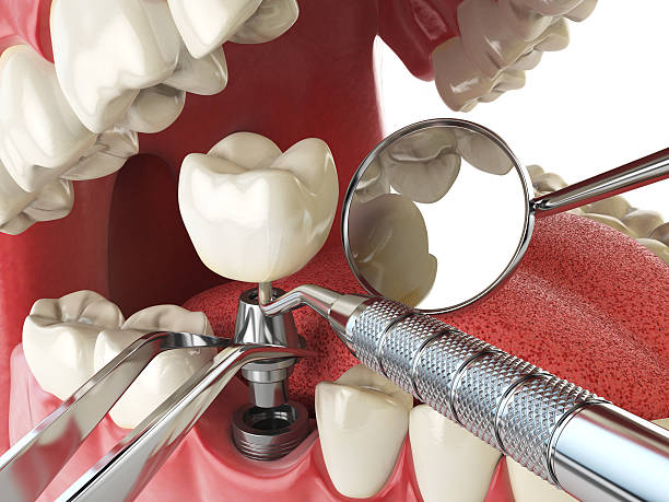 Best Emergency Treatment for Dental Infections or Abscesses in River Road, NC